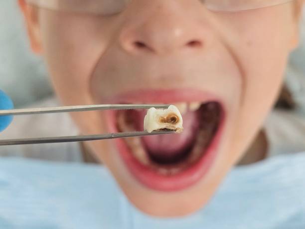 Best Emergency Root Canal Treatment in Bonneau Beach, SC